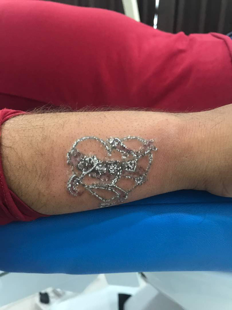 first time laser tattoo removal treatment 