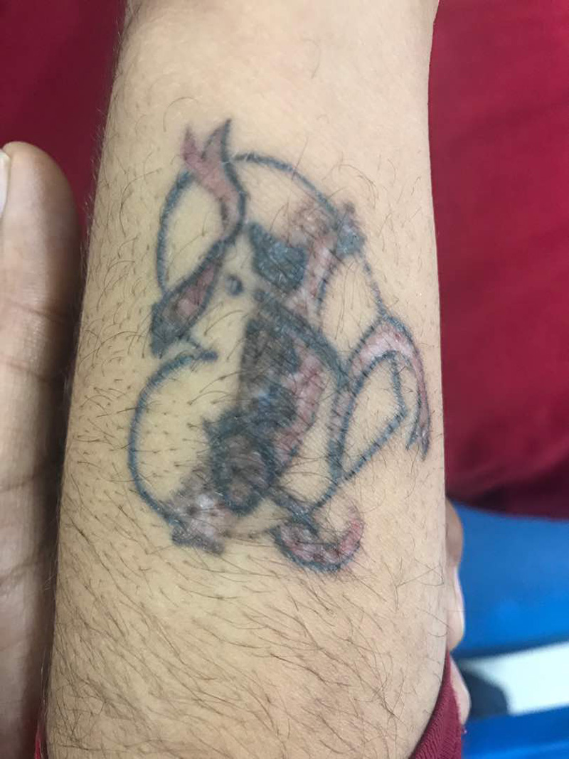 first time laser tattoo removal treatment 