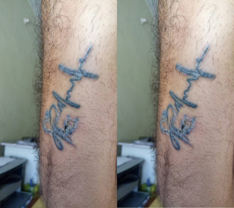 laser tattoo removal result