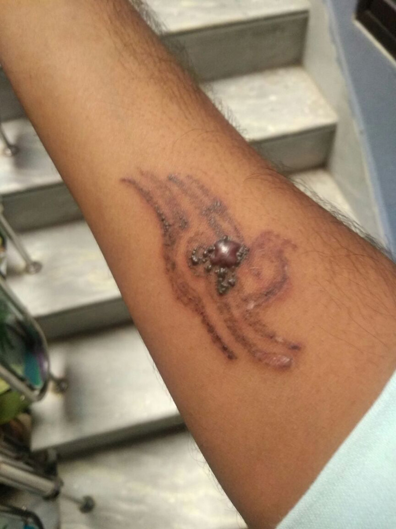 laser tattoo removal result